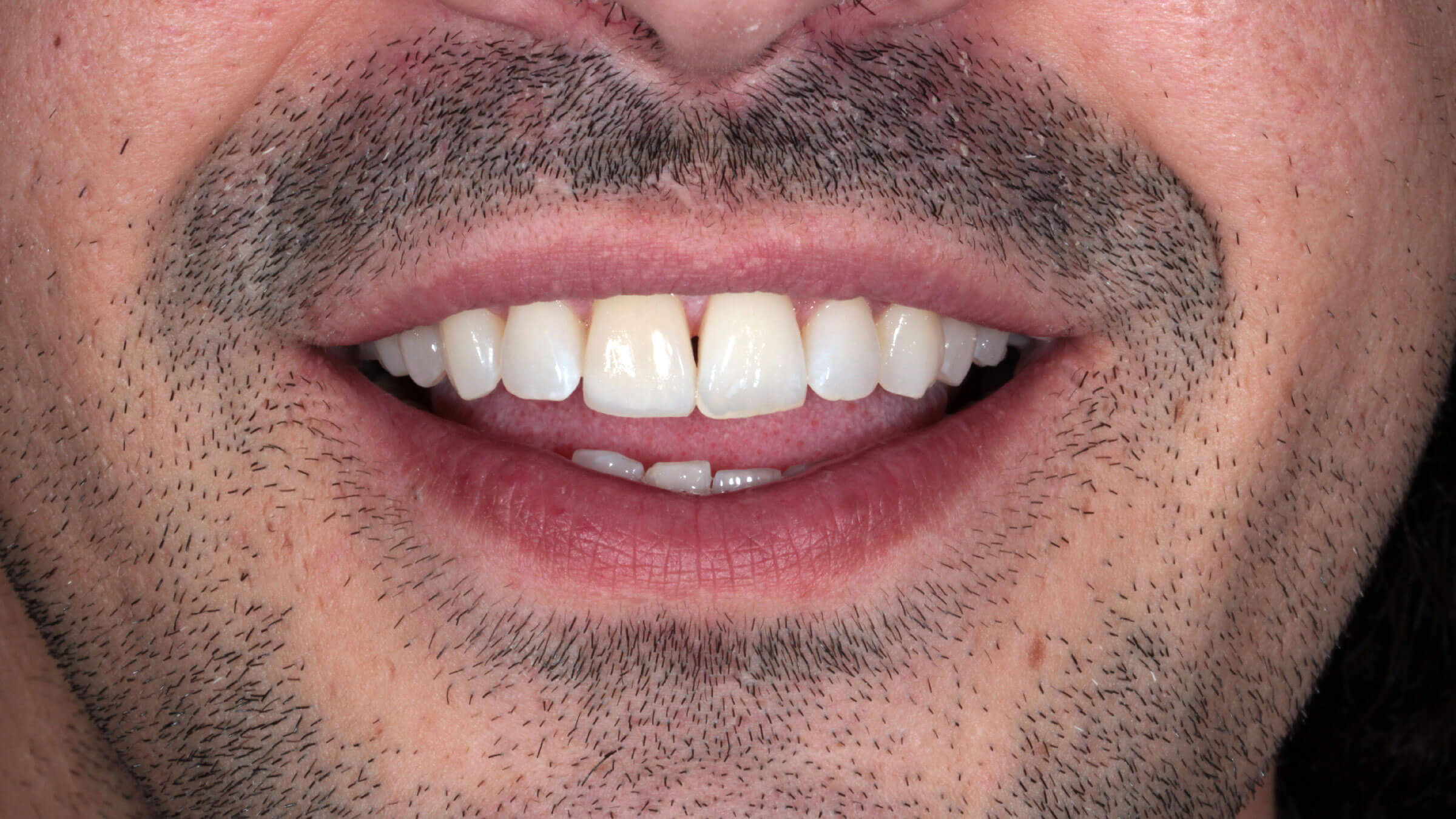 Ergebnis Bleaching der Zähne